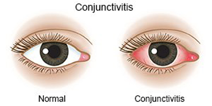 Conjunctivitis spreading rapidly in City; Experts urge General Public to take precautions - ANDAMAN SHEEKHA